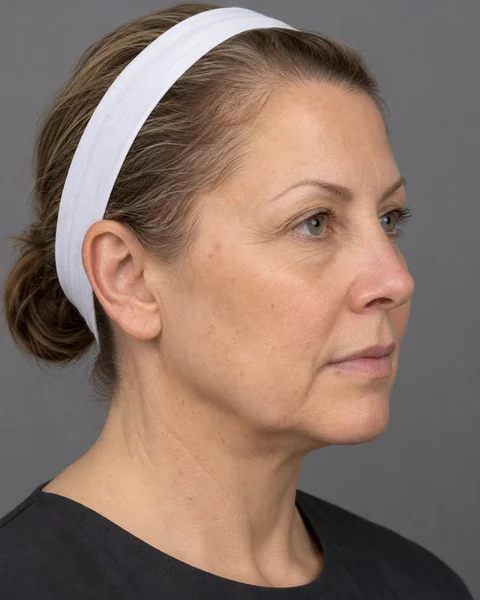 Illustrative image — Softened contours along the jawline and hairline, view 2