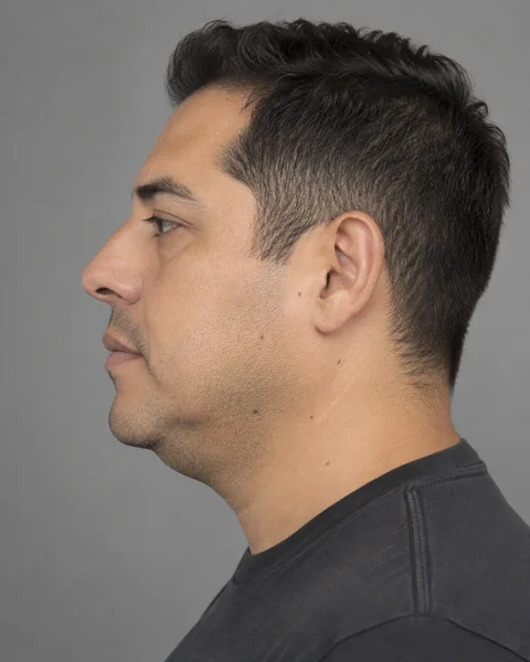 Illustrative image — Fullness under the chin, view 1