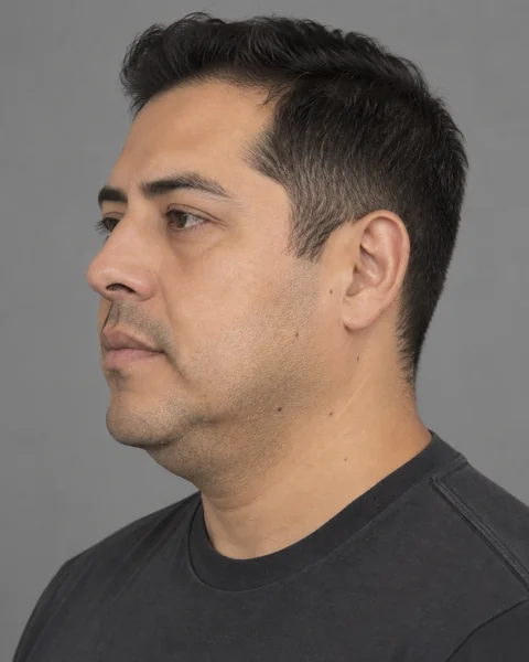 Illustrative image — Fullness under the chin, view 2