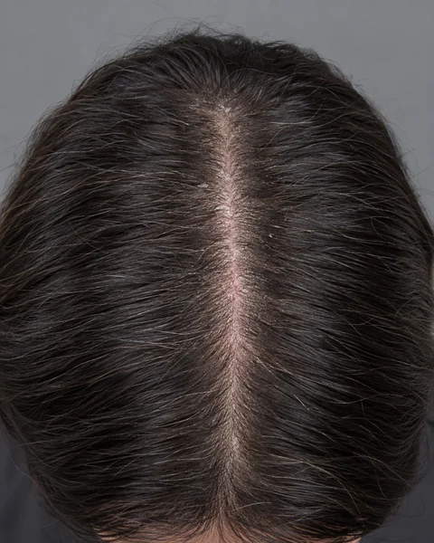 Illustrative image — A dry, sensitive-feeling scalp, view 1