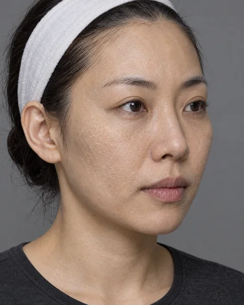 Illustrative image — Dehydrated skin that has lost its sheen, view 1